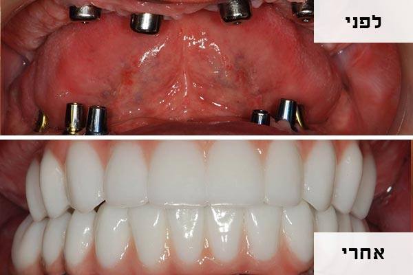 החסרונות של השתלות ביום אחד - השתלת שיניים ביום אחד - לפני ואחרי - דר אלכסנדר