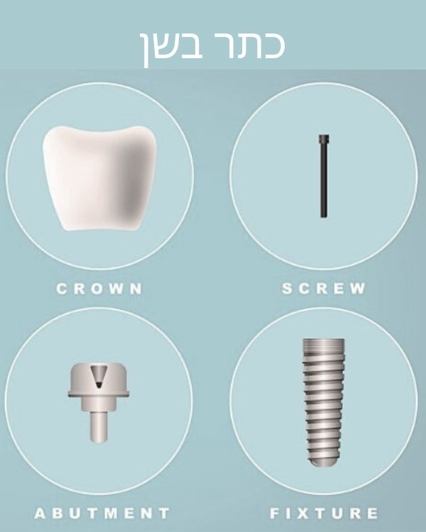 מהו מבנה ואיך הוא קשור לכתר בשן - מרפאת שיניים דר אלכסנדר