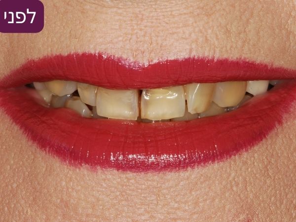 השתלת שיניים דר אלכסנדר - לפני - דוגמה 3