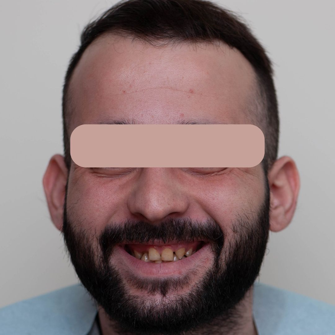 השתלת שיניים לפני ואחרי - מטעם מרפאת שיניים דר אלכסנדר (5)