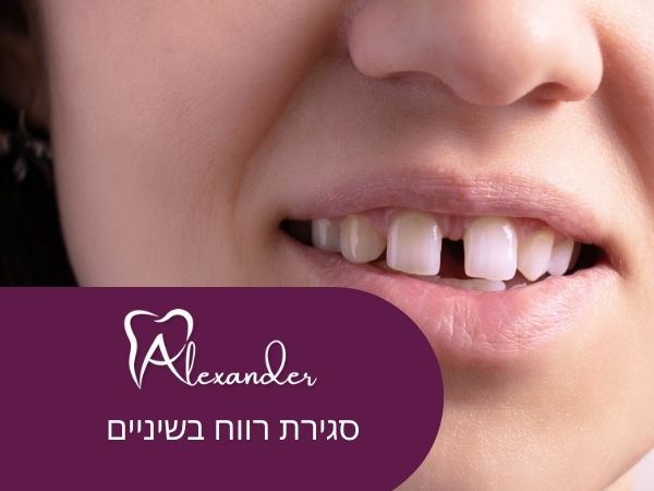 סגירת רווח בשיניים - מטעם מרפאת דר אלכסנדר