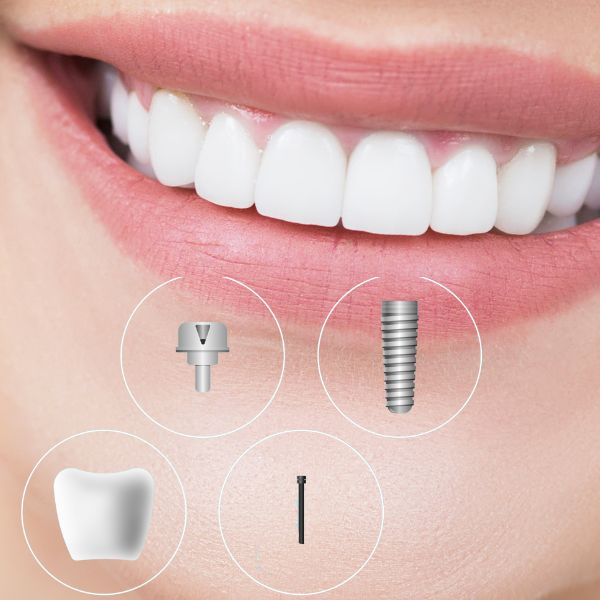 שאלות נפוצות על השתלת שיניים ביום אחד - של מרפאת שיניים דר אלכסנדר