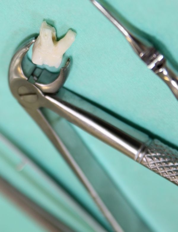 הליך עקירת השן העקירה כירורגית - כלים לעקירת שן - דר אלכסנדר