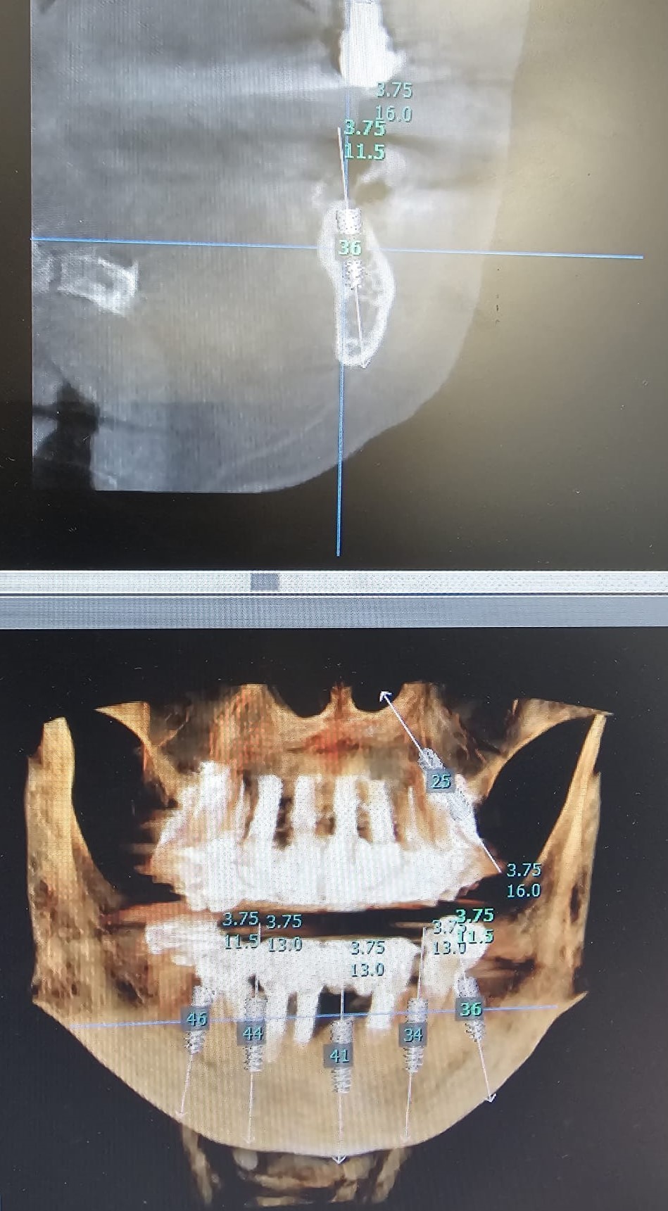כיצד מתבצע הליך ציפוי שיניים - צילום דיגיטלי - דר אלכסנדר