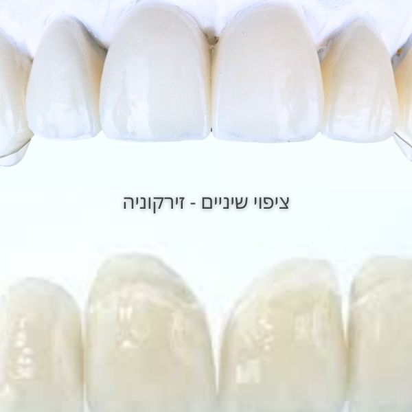 ציפוי שיניים זירקוניה - החומר העמיד והחזק לציפוי שיניים - דר אלכסנדר