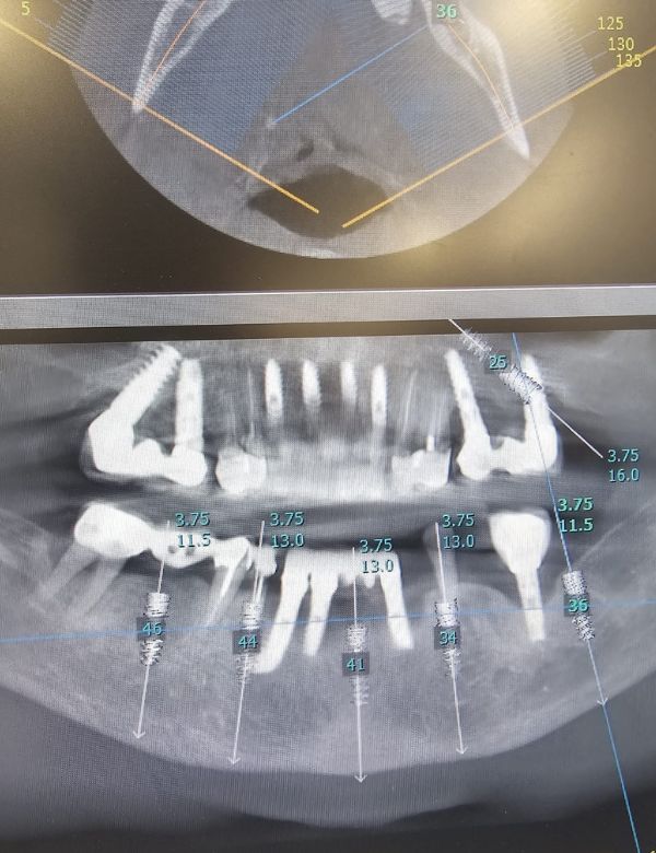 שיקום הפה - סריקת שיניים דיגיטלית - מרפאת שיניים דר אלכסנדר