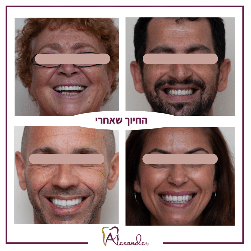 מרפאת שיניים דר אלכסנדר - לפני ואחרי (1)