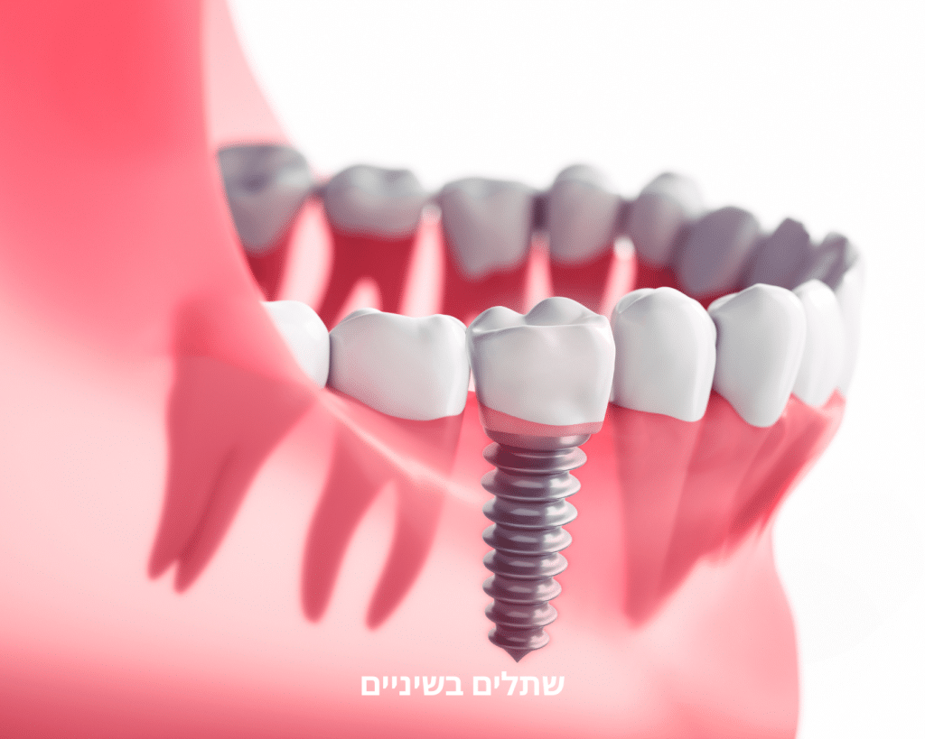 שתלים בשיניים - מרפאת שיניים אלכסנדר