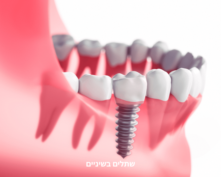 שתלים בשיניים - מרפאת שיניים אלכסנדר