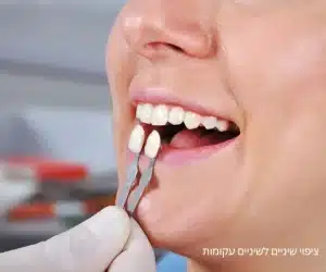ציפוי שיניים לשיניים עקומות - מרפאת ד"ר אלכסנדר