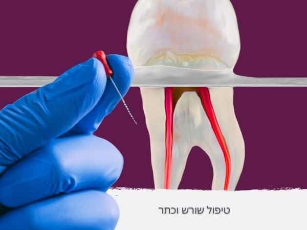 טיפול שורש וכתר - מאמר דר אלכסנדר
