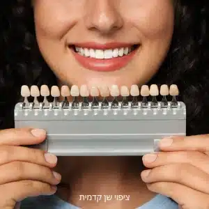 ציפוי שן קדמית