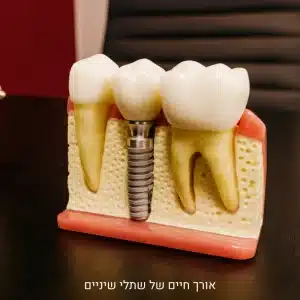 אורך חיים של שתלים דנטליים – כמה זמן מחזיקים שתלי שיניים