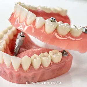 סימני דחיית שתל שיניים – איך לזהות ומה לעשות