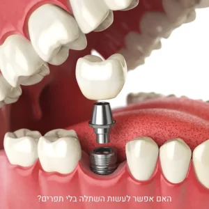 השתלת שיניים ללא תפרים – איך זה מתבצע בפועל
