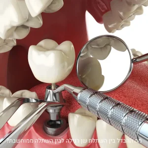 השתלת שיניים רגילה לעומת השתלה ממוחשבת – המחשה קלינית של מיקום השתל
