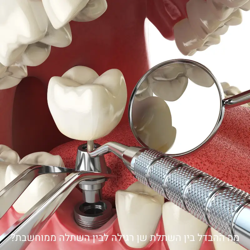 השתלת שיניים רגילה לעומת השתלה ממוחשבת – המחשה קלינית של מיקום השתל