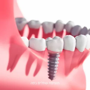 חשיפת שתלים בפה לפני התקנת כתר קבוע