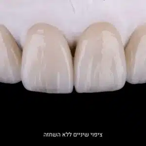 ציפוי שיניים ללא השחזה במראה טבעי