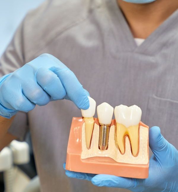 Имплантации и реставрация зубов за один день - Д-р Александр