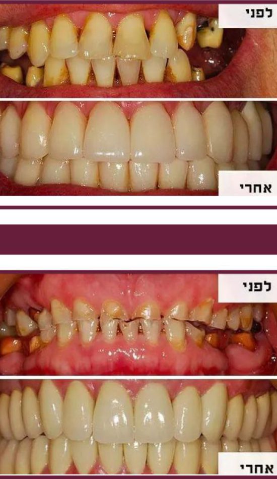 השתלת שיניים למעשנים - לפני ואחרי טיפול - מרפאת דר אלכסנדר