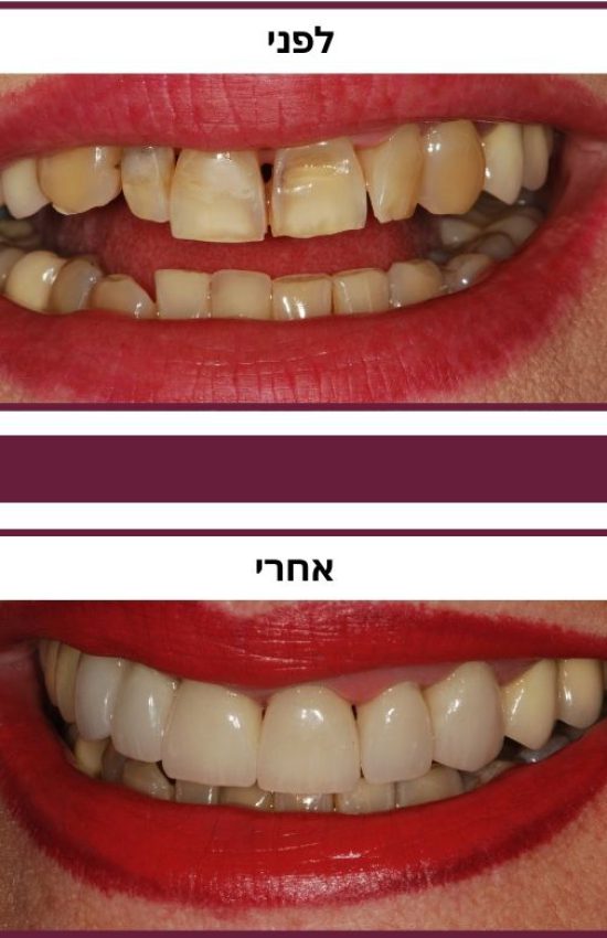 השתלת שיניים קדמיות - מטעם ממרפאת דר אלכסנדר