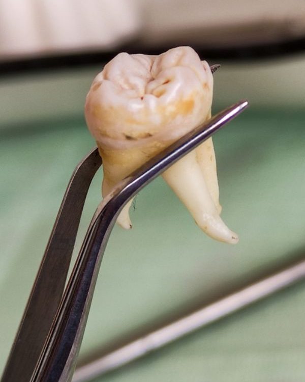 טיפולי שיניים - עקירת שן - דר אלכסנדר