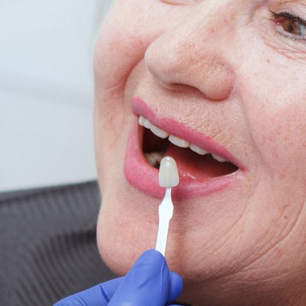 טיפולי שיניים - ציפוי שיניים - מרפאה של דר אלכסנדר