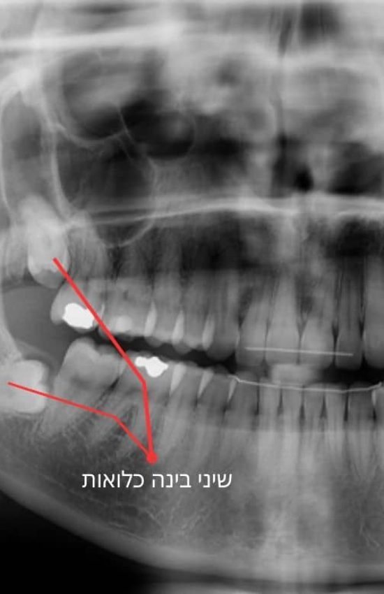 שיני בינה כלואות - כירורג שיניים דר אלכסנדר